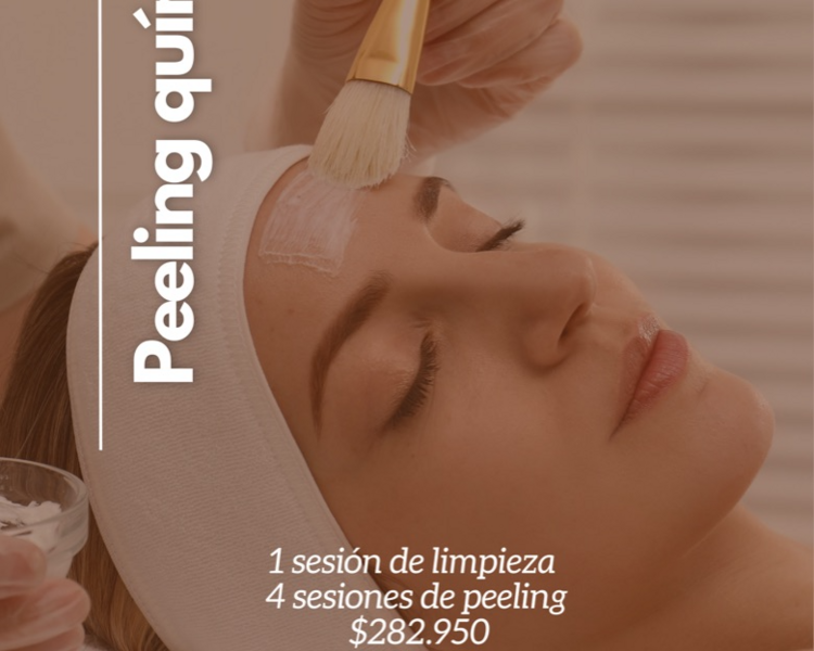 Peeling químico facial ( 4 sesiones )