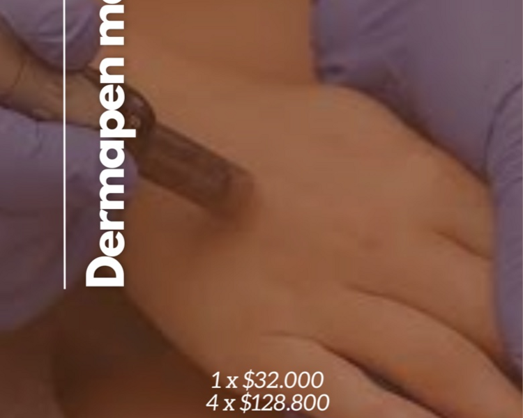 Dermapen de manos ( 4 sesiones)