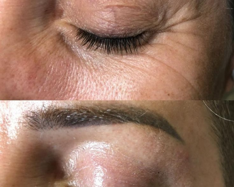 TERCIO SUPERIOR - Plasma Pen / Fibroblast 