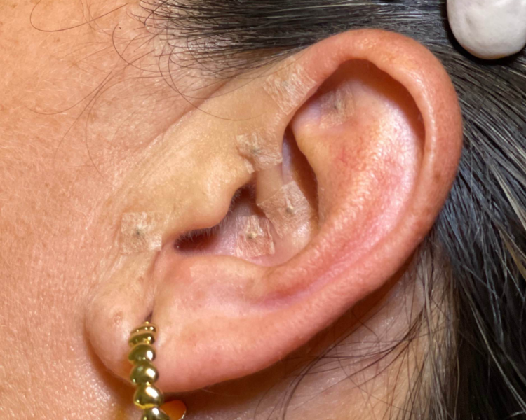 Sesión de Auriculoterapia