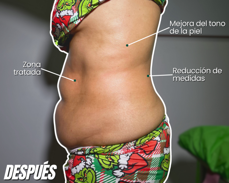 Sesión de Lipolítico + Drenaje 