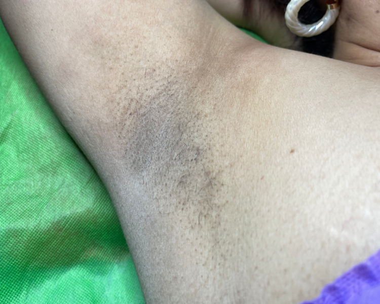 Despigmentación de Zonas Nigris 