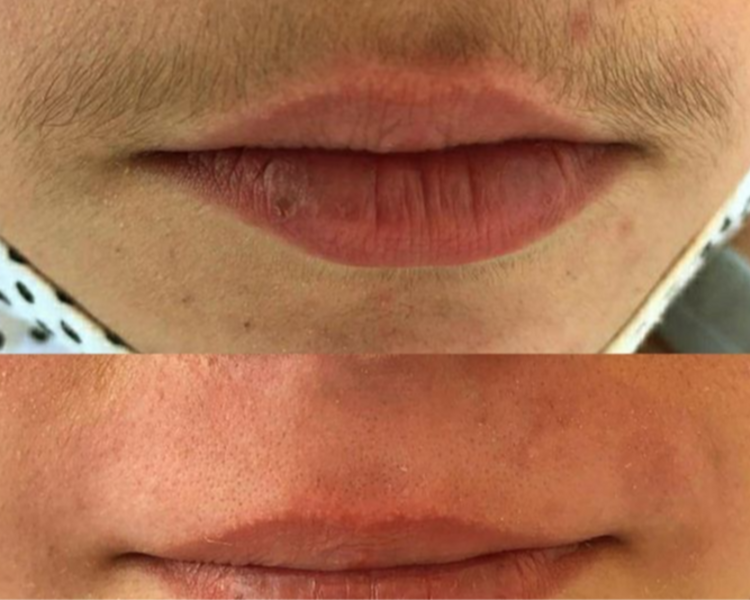 DEPILACION BOZO - PERFILADOR