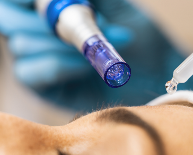 MICRONEEDLING/ DERMAPEN FACIAL