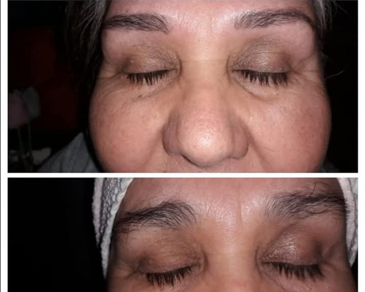Lifting de cejas y perfilado