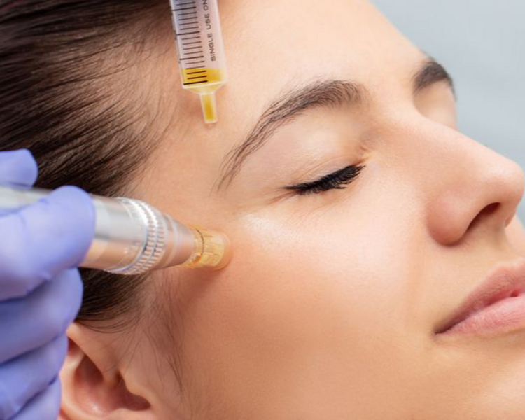 PLASMA RICO EN PLAQUETAS CON LIMPIEZA FACIAL