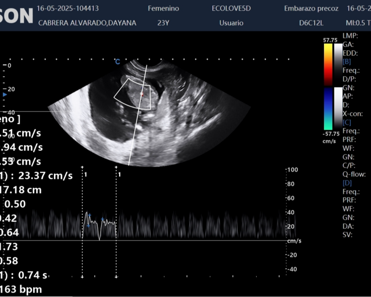 Ecografía Doppler 1er Trimestre (11-14 semanas)