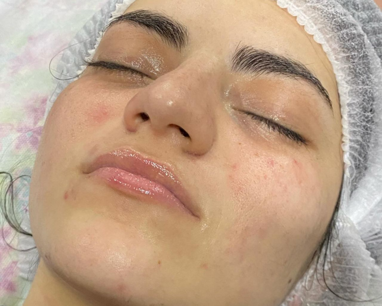 Limpieza Facial Profunda + Dermaplaning