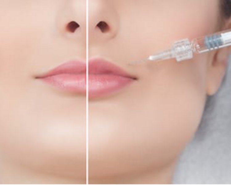 Relleno de labios con ácido hialurónico 