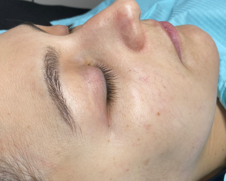 Tratamiento facial personalizado con microneedling (Dermapen)