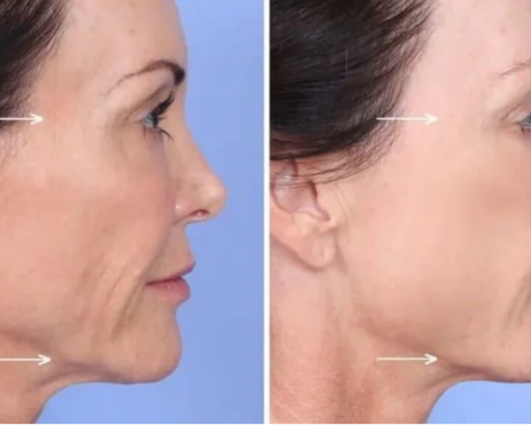 Sculptra 