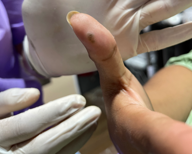 Cauterización de verrugas