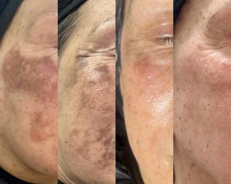 MESOTERAPIA HIPERPIGMENTACION//MELASMA