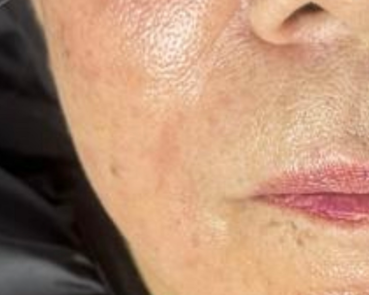 MESOTERAPIA HIPERPIGMENTACION//MELASMA