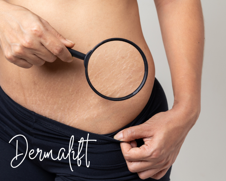 Dermalift