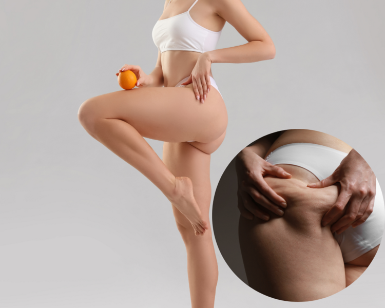 Bye Bye Celulitis 