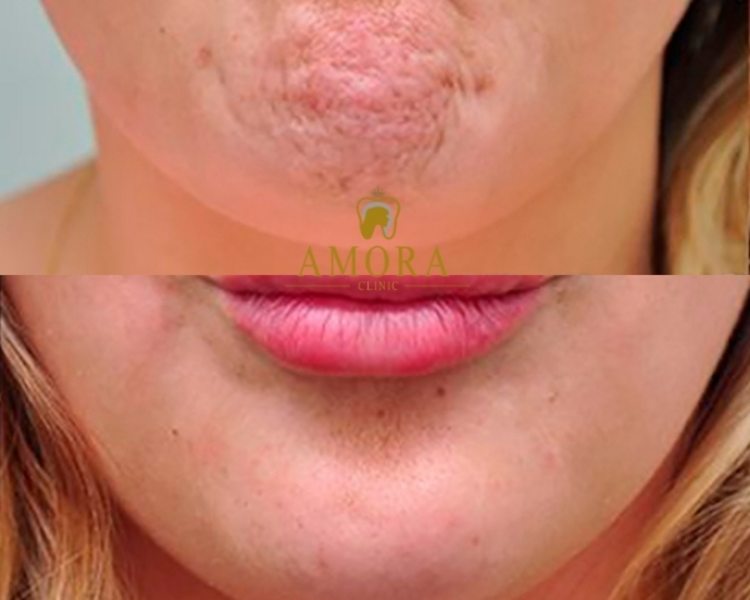 Mentón de empedrado o celulítico