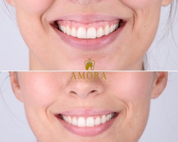 Sonrisa gingival- Miomodulación