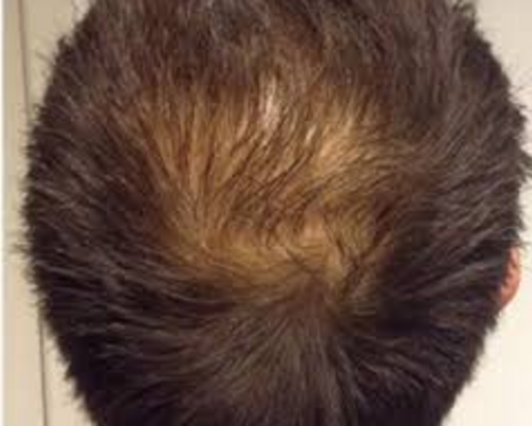 Mesoterapia  Capilar  (6 sesiones de ácido hialurónico + 3 sesiones de plasma rico en plaquetas) 