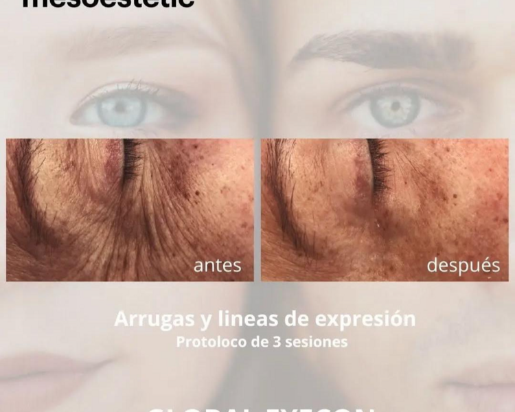 mesoterapia pericular despigmentante Global eyecon (peeling, meso con microneedling y mask)
