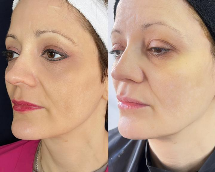 Radiesse x 2 jeringas 