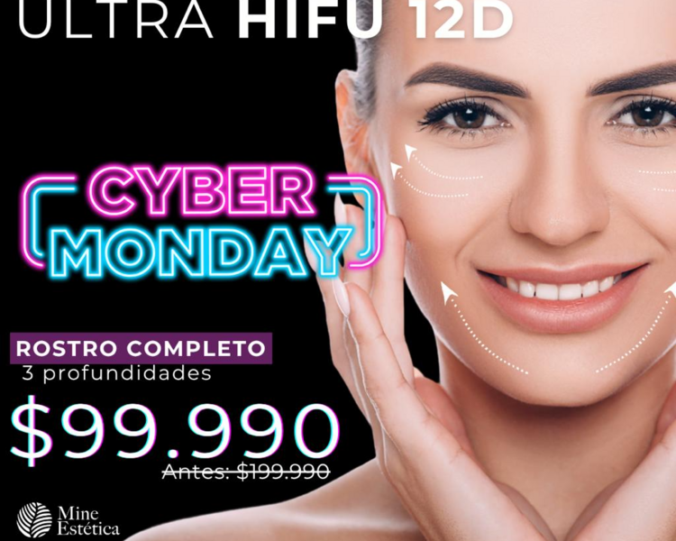 CYBER ULTRA HIFU 12D ROSTRO COMPLETO 