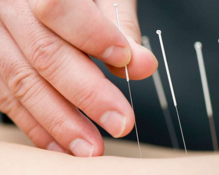 ACUPUNTURA