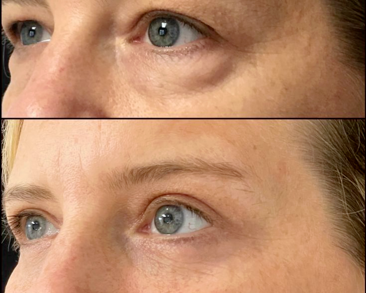 Atenuación bolsas de ojeras - (Pack 3 sesiones)