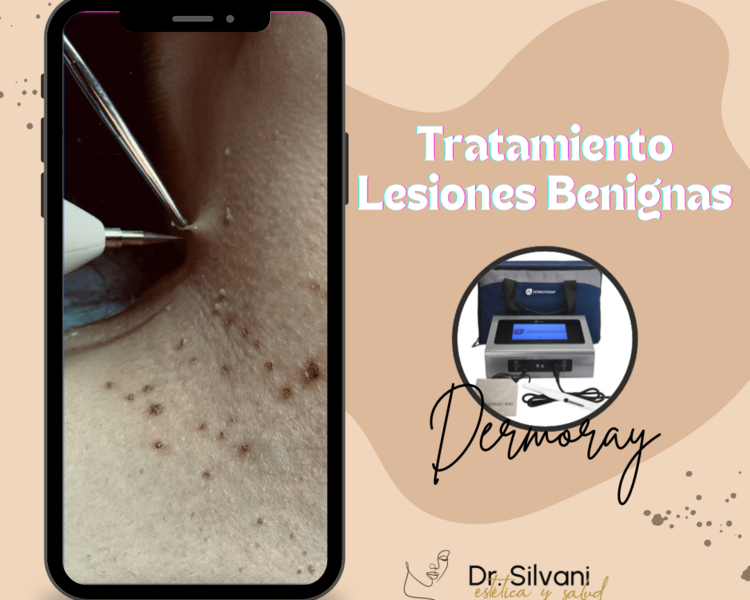 Ablacion de lesion con Tecnologia Plasma (Corporal)