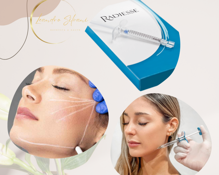 Bioestimulacion con Radiesse