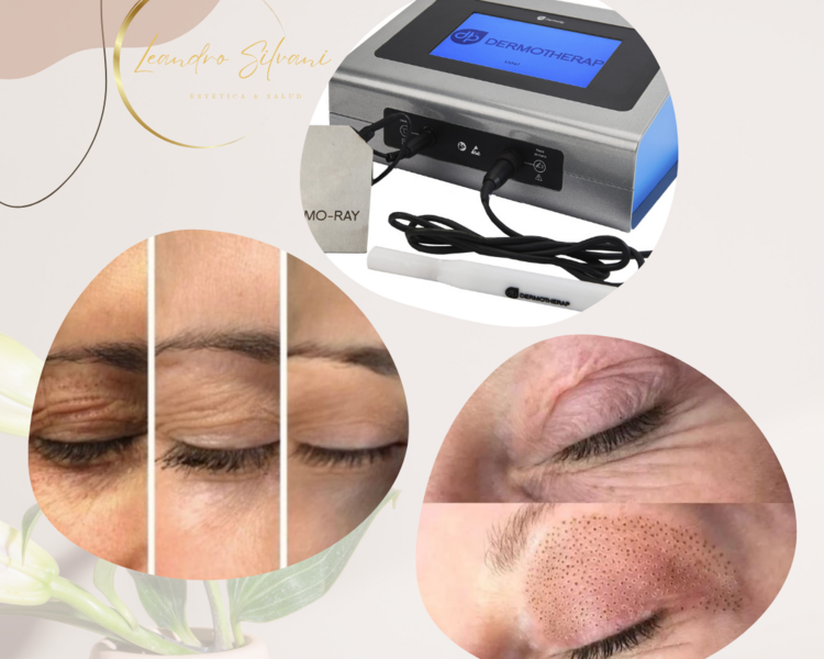Blefaroplastia con tecnologia Plasma