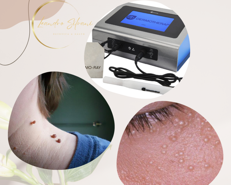 Ablacion de lesion con Tecnologia Plasma (Facial)