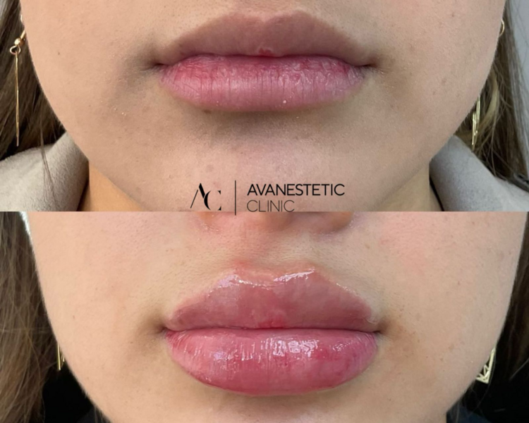 Relleno de Labios CyberDay Junio25