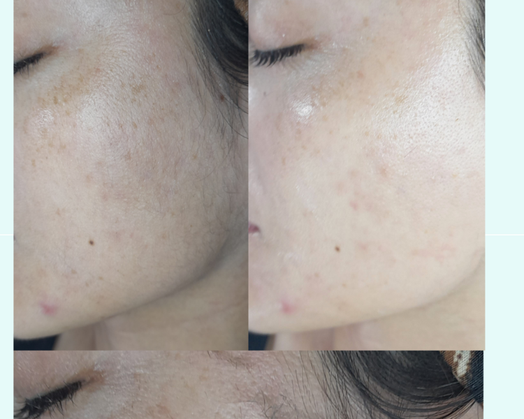 Dermaplaning