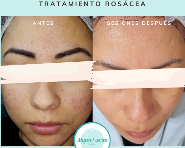 Tratamiento de Rosácea 