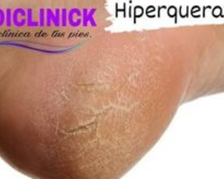HIPERQUERATOSIS (callosidades)