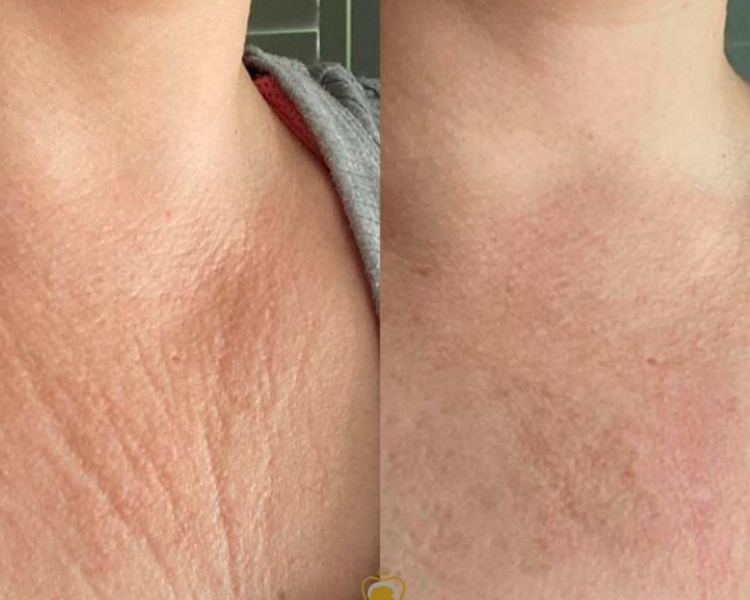 Bioestimulador inyectable Novuma 