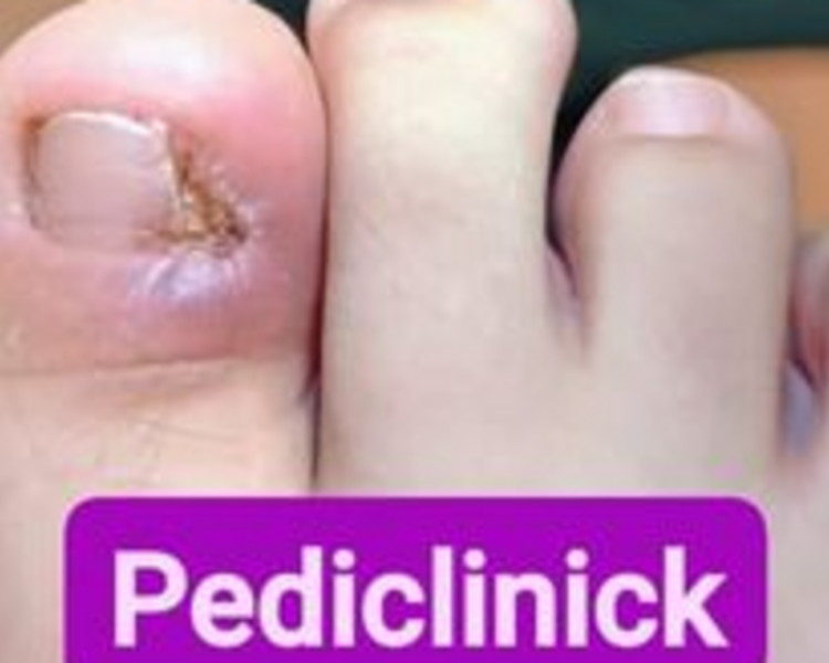 ONICOCRIPTOSIS (uña incarnada)