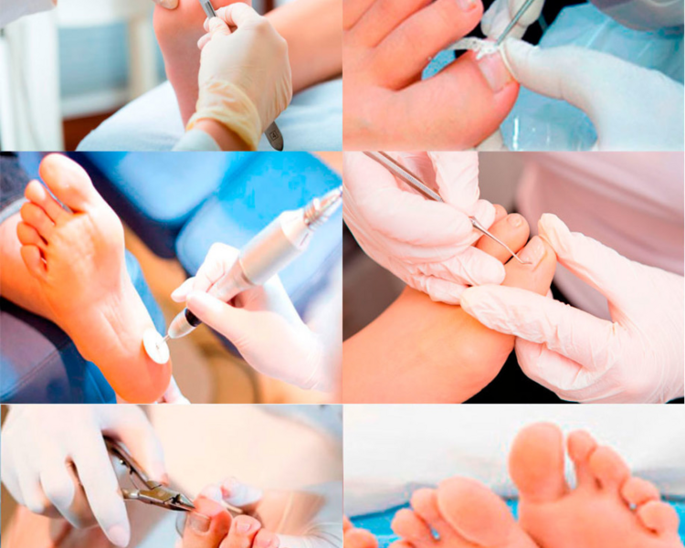 PEDICURE CORRECTIVO