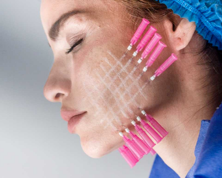 Hilos bioestimuladores lisos