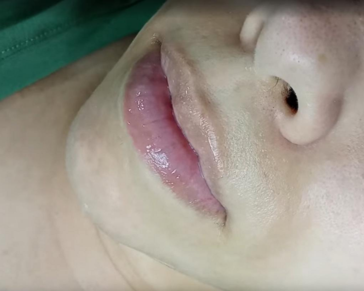 Hydra BB Lips