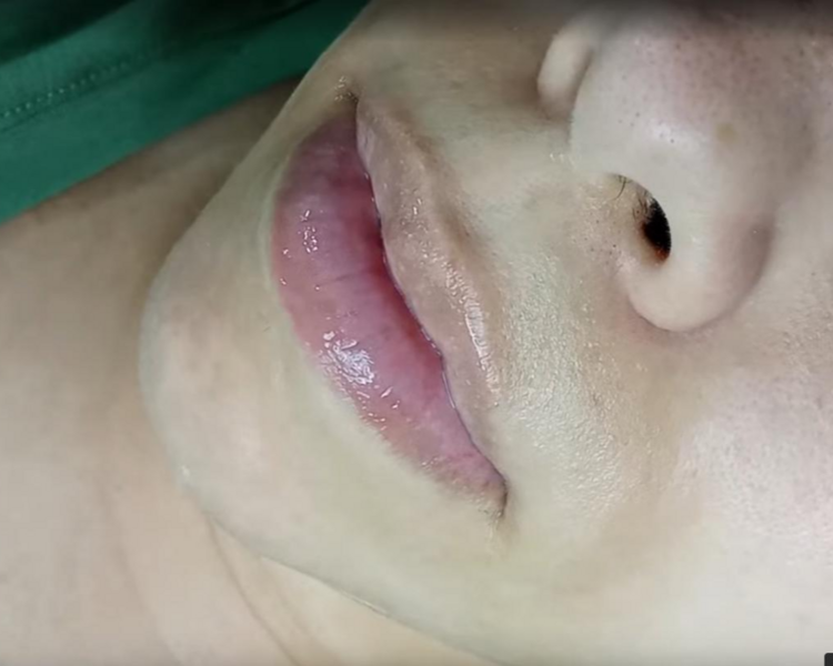 Hydra BB Lips