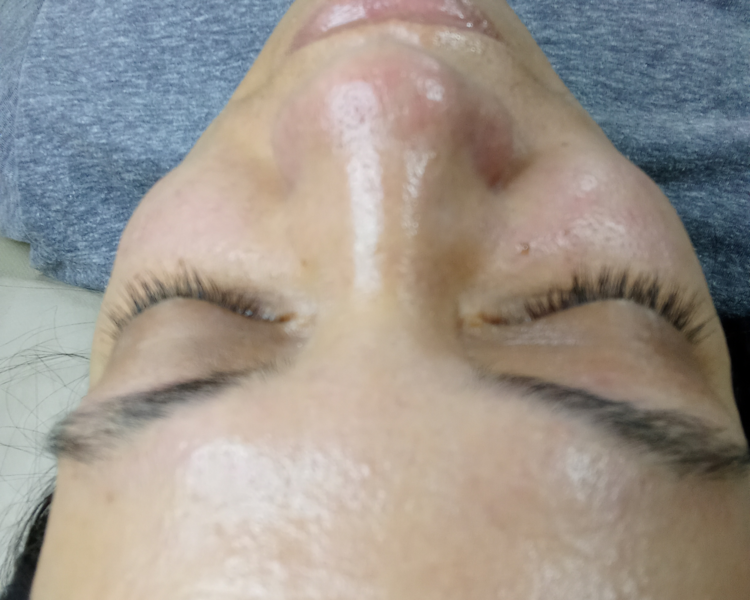 Limpieza Facial profunda con extracciones