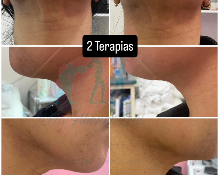 Primera etapa de rehabilitación Postquirúrgico facial