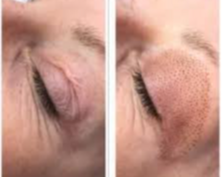 Blefaroplastia Plasmed