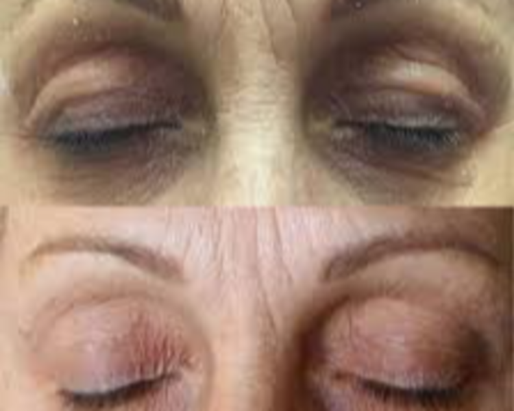 Blefaroplastia Plasmed