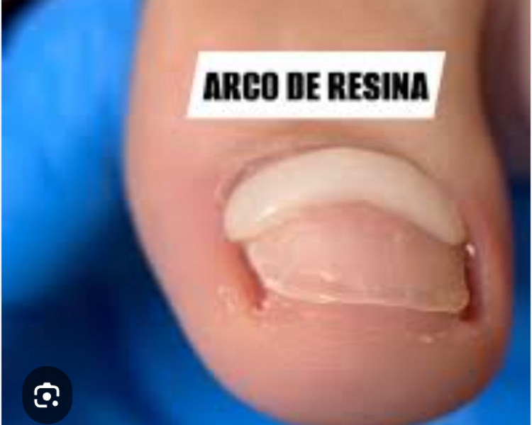 Tratamiento de Ortonixia 