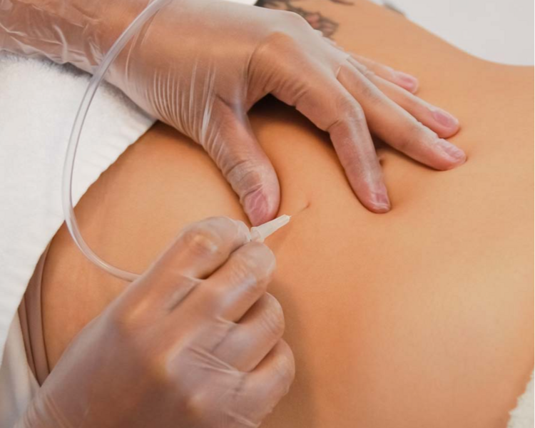 CARBOXITERAPIA ABDOMEN LATERALES Y ESPALDA