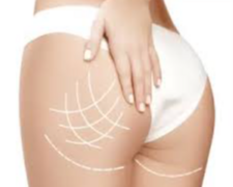 Paquete 5 sesiones Gluteo