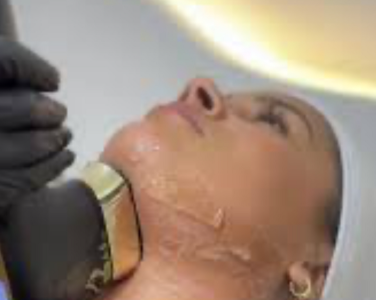 HIFU 22 D facial completo con papada